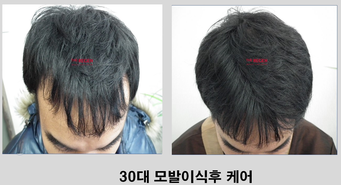 30대 모발이식후 케어 before after
